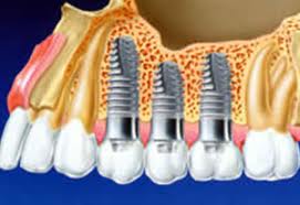 Photo: Trois implants sur la mâchoire supérieure