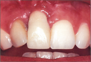 Photo: positionnement d'implant non optimal