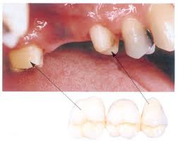 Photo: rotation des dents adjacentes lors de l'installation d'un pont