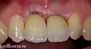 Photo: rejet de l'implant dentaire