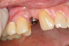 Photo: implant installé