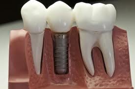 Photo: implant installé