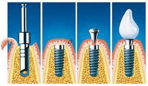 Photo: étapes d'installation de l'implant