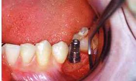 Photo: implantation
