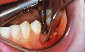 Photo: vissage de l'implant
