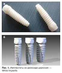 Photo: implants en zirconium et titane