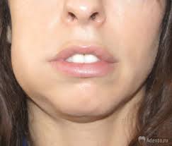 Photo: œdème facial après implantation