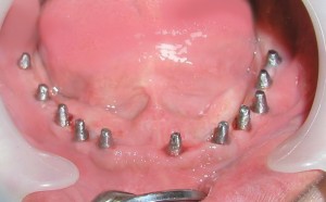 après implantation