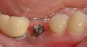 Photo: réimplantite