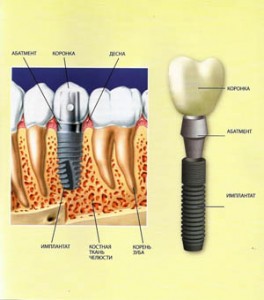 Photo: Structure de l'implant