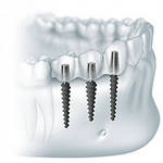 Photo: implantation endoscopique