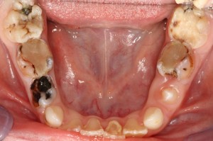 Photo: Exécution de caries
