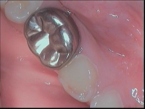 Photo: couronne de dent en métal sur une dent de bébé