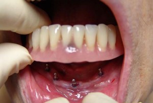 Photo: implantation et prothèses amovibles
