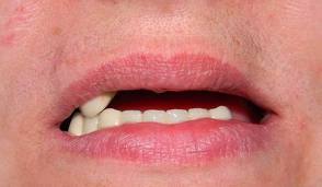 Photo: Absence partielle de dents Indication pour la pose de la prothèse.