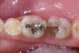 Photo: Prothèses de dents de lait avec languettes dentaires