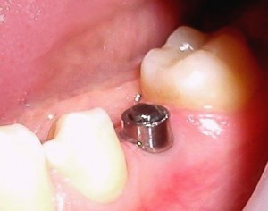 Photo: implant installé