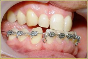 Photo: Correction de la dentition de la mâchoire inférieure