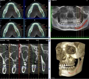 Photo: planification 3D avant implantation