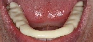Photo: Restauration de l'émail des dents à l'aide d'applications