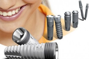 Photo: Implants dentaires