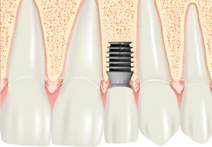 Photo: implantation Bicon