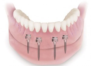 Photo: implantation d'une ponction gingivale
