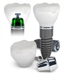 Photo: implants Astra Tech