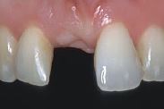 Photo: Indication d'implantation