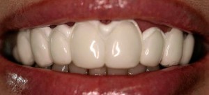 Photo: Restauration de l'émail par reminéralisation des dents