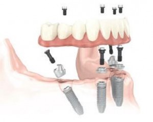 Photo: Implantation d'implant à un angle