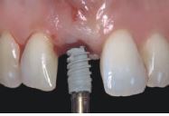 Photo: placement de l'implant