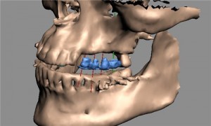 Photo: modèle de pose d'implant chirurgical