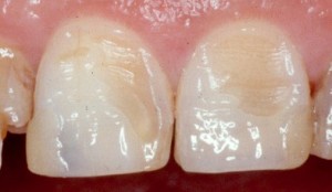 Photo: Érosion de l'émail des dents
