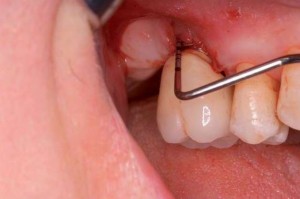 Photo: saignement après implantation