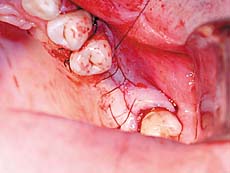 Photo: Surface de la plaie après la pose de l'implant