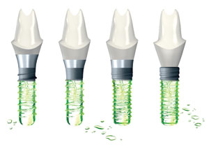 Photo: implants Straumann