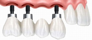 Photo: Prothèses sur implants