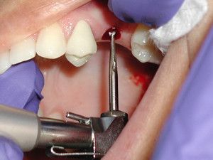 Photo: Procédure d'implantation d'implant