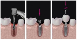 Photo: étapes d'installation de l'implant