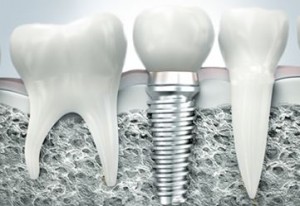 Photo: implant Ankylos