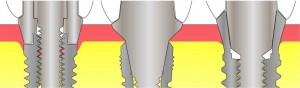 Photo: hexagones externes, avec hexagone interne, transgynygal
