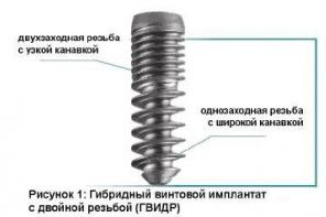 Photo: Ards Implant
