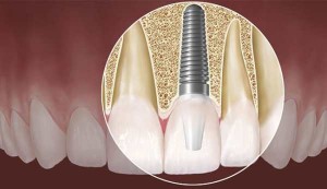 Photo: implantation immédiate