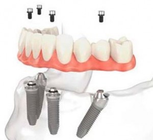 Photo: Installation d'implants à un angle