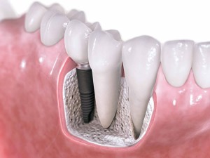 Photo: implant dentaire