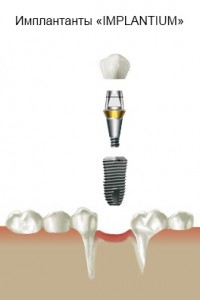 Photo: Implantium Implant