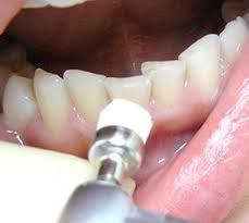Photo: Nettoyage des dents de la plaque avant l'installation des facettes