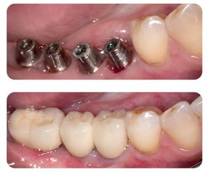 Photo: Prothèses sur implants avant et après