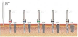 Photo: Variétés d'implants